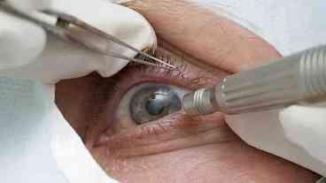 Covid-19 faz cair detecção precoce de glaucoma